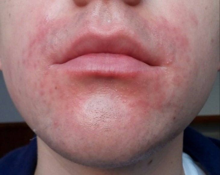 Chăm sóc dịu nhẹ giúp giảm đỏ rát và phục hồi vùng da quanh miệng bị kích ứng