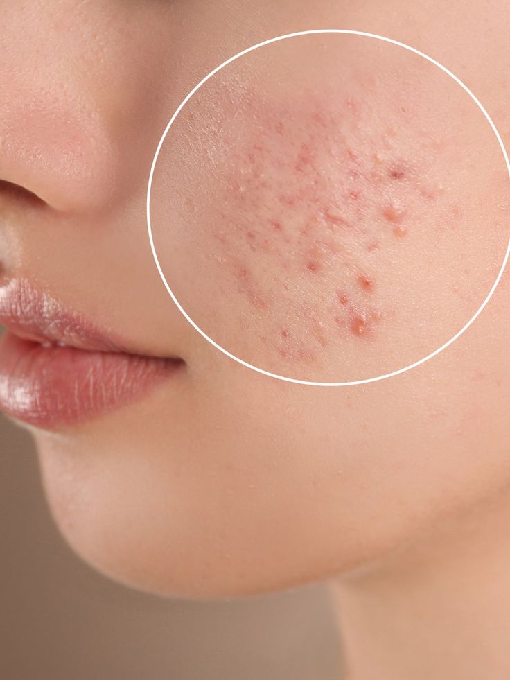 Các công nghệ laser phổ biến trong trị mụn