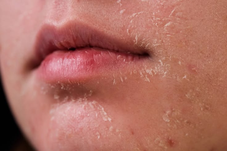 Da khô có thể liên quan đến tình trạng thiếu vitamin D