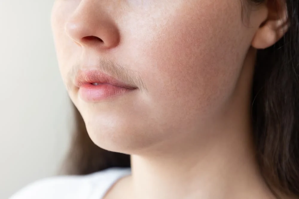PCOS còn gây rậm lông, rụng tóc và các mảng da sẫm màu