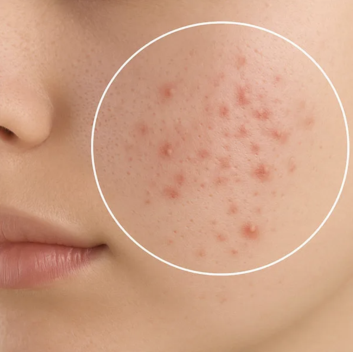 Ma sát và môi trường nóng ẩm dưới khẩu trang góp phần gây mụn, đỏ da và kích ứng