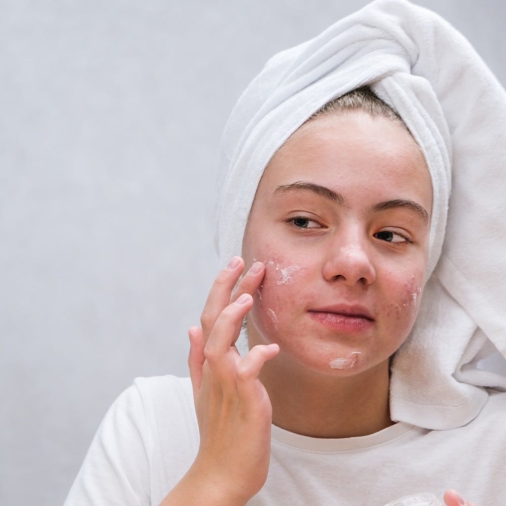 Kiểm soát mụn sớm là cách giúp giảm nguy cơ hình thành sẹo mụn hiệu quả hơn