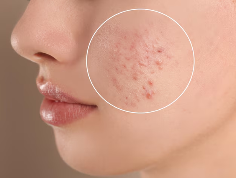 Mụn trứng cá là bệnh viêm da mạn tính với cơ chế viêm kéo dài trong da