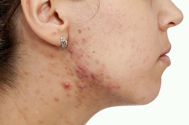 Mụn nội tiết tập trung ở cằm và quai hàm là dấu hiệu thường gặp của rối loạn hormone