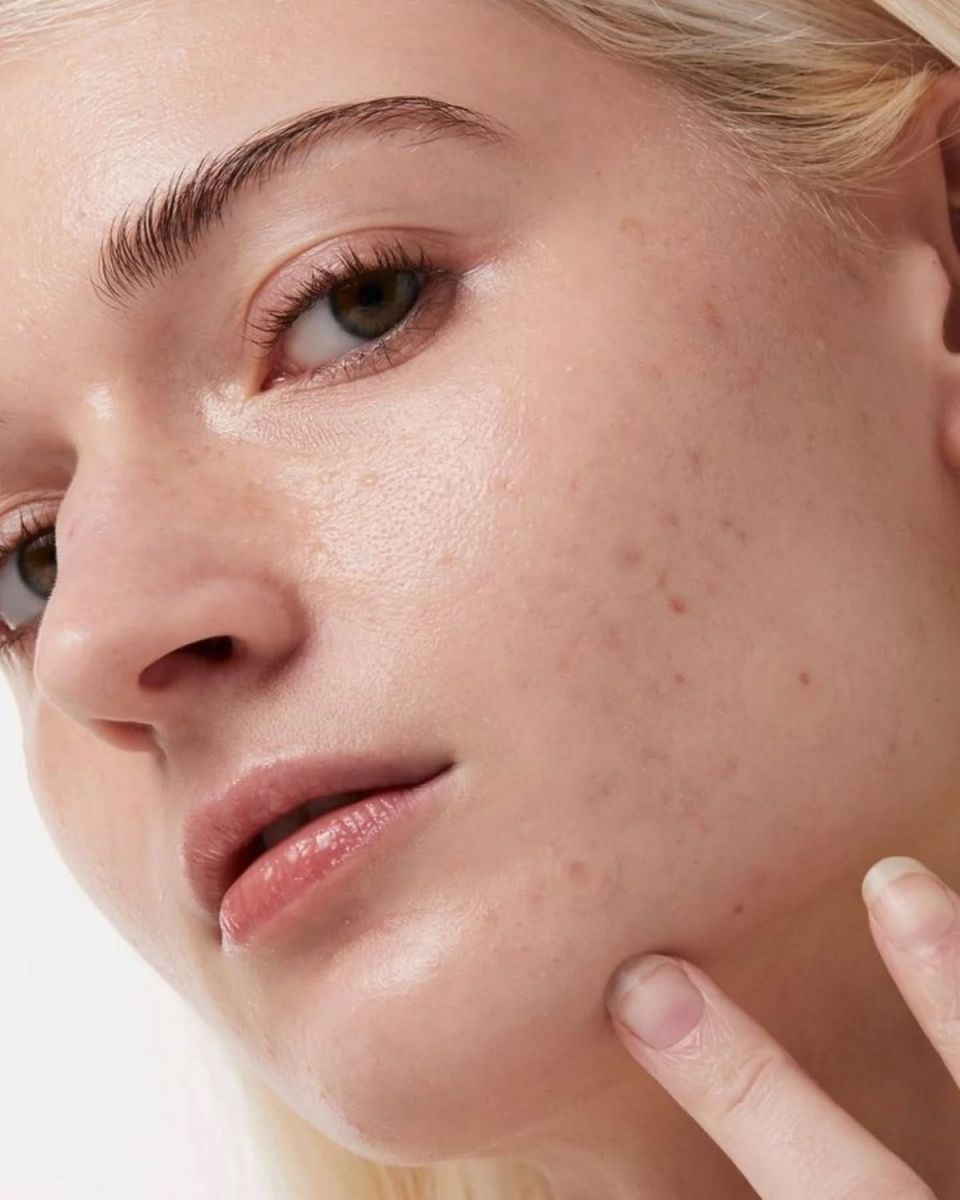 Những sai lầm chăm da khiến mụn tuổi dậy thì nặng hơn và kéo dài hơn