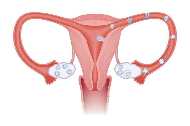 Da dầu và bít tắc lỗ chân lông là hai yếu tố chính làm mụn tuổi dậy thì xuất hiện