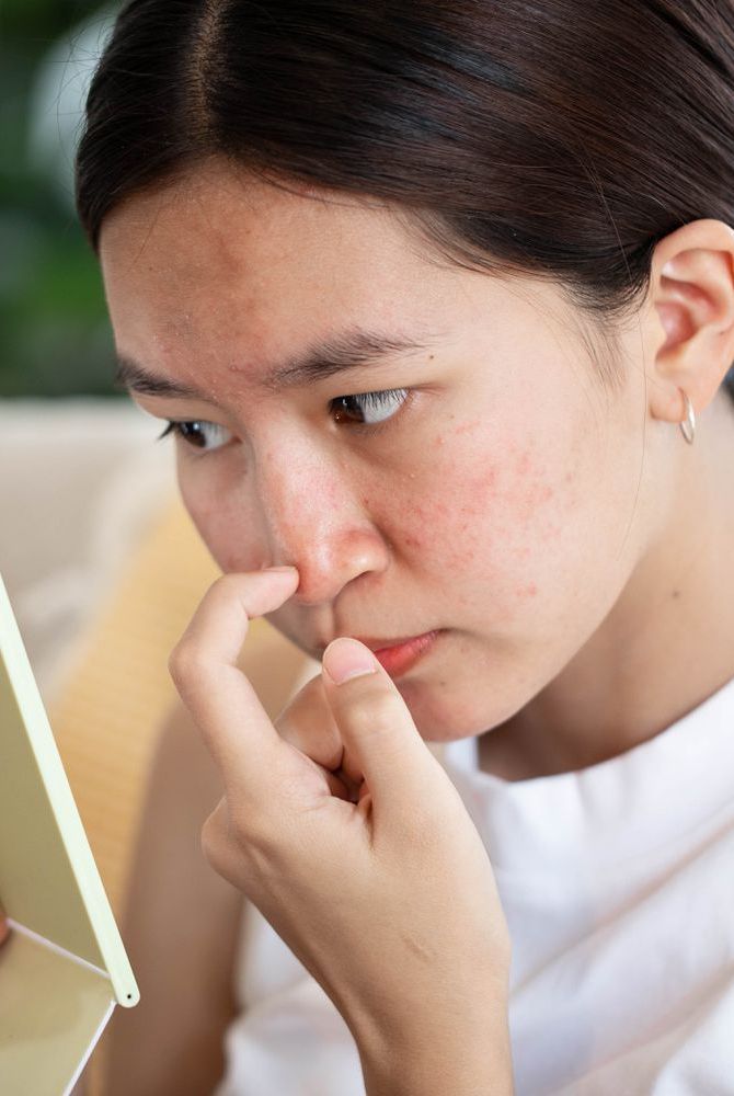 Bôi chanh có thể khiến da bị kích ứng