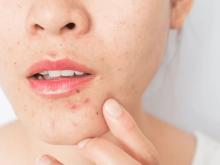 Quan sát vị trí mụn trên cằm và quai hàm giúp định hướng nguyên nhân mụn có thể liên quan đến nội tiết
