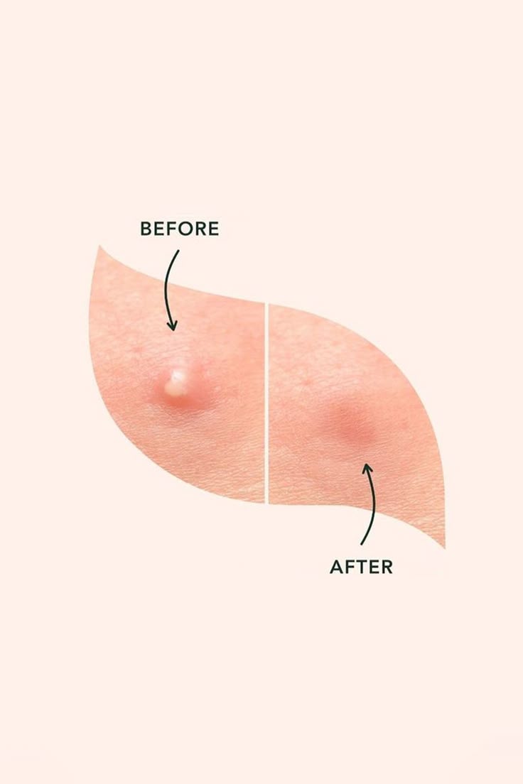 Miếng dán mụn giúp giảm viêm