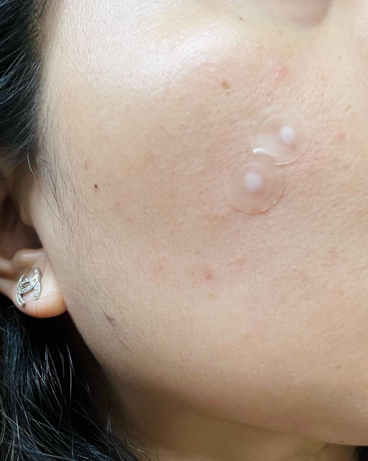 Miếng dán mụn hiệu quả nếu dùng đúng cách
