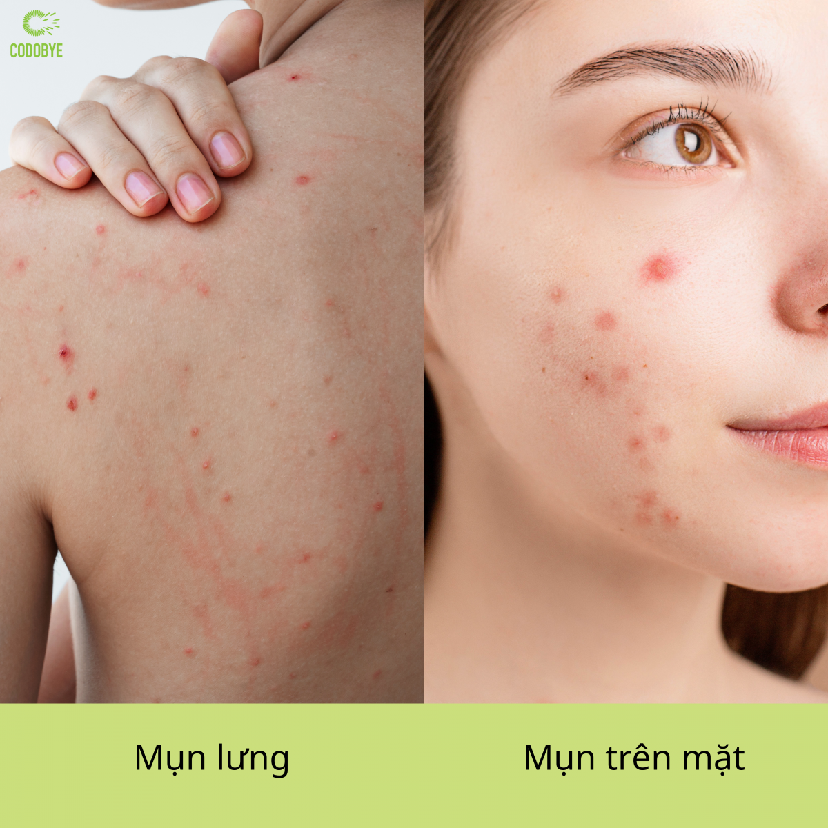 Mụn mặt và mụn lưng cần cách chăm sóc khác nhau để kiểm soát mụn hiệu quả