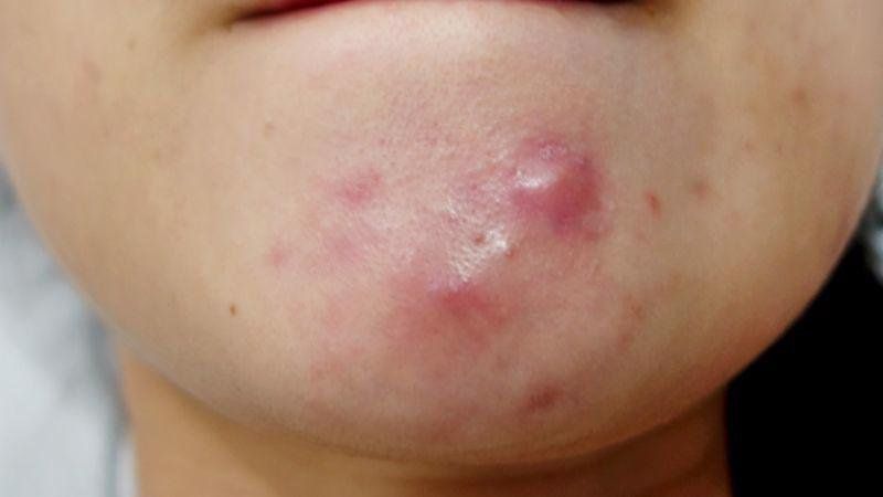 Mụn nang sâu ở quai hàm, sưng đỏ và khó điều trị