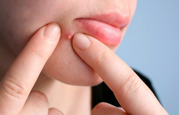 Thói quen nặn mụn bằng tay có thể khiến vết thâm mụn đậm màu và lâu mờ hơn